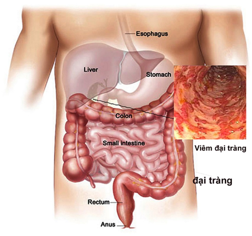 Chi tiet cac buoc kham phat hien ung thu dai trang-Hinh-10