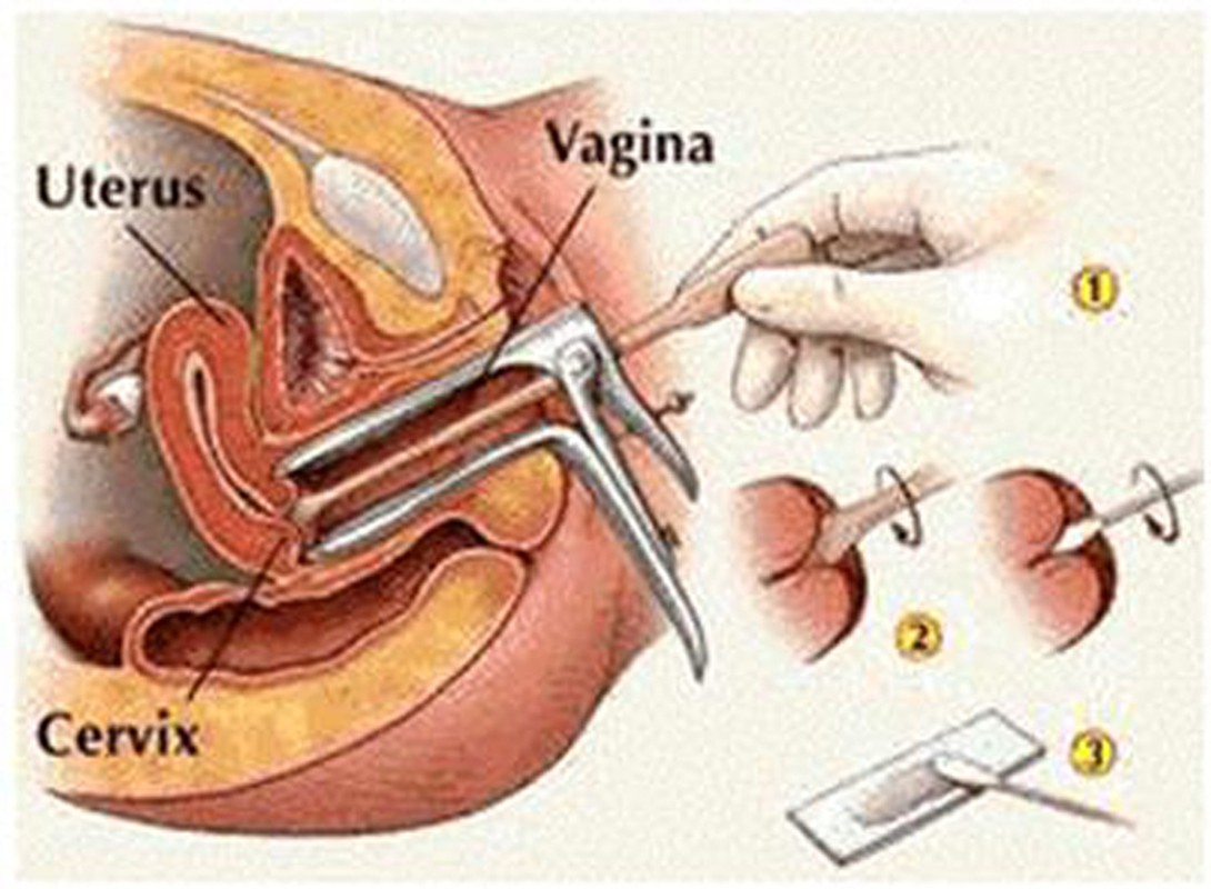 Cach ngan ngua virus HPV gay ung thu, mun coc sinh duc-Hinh-8