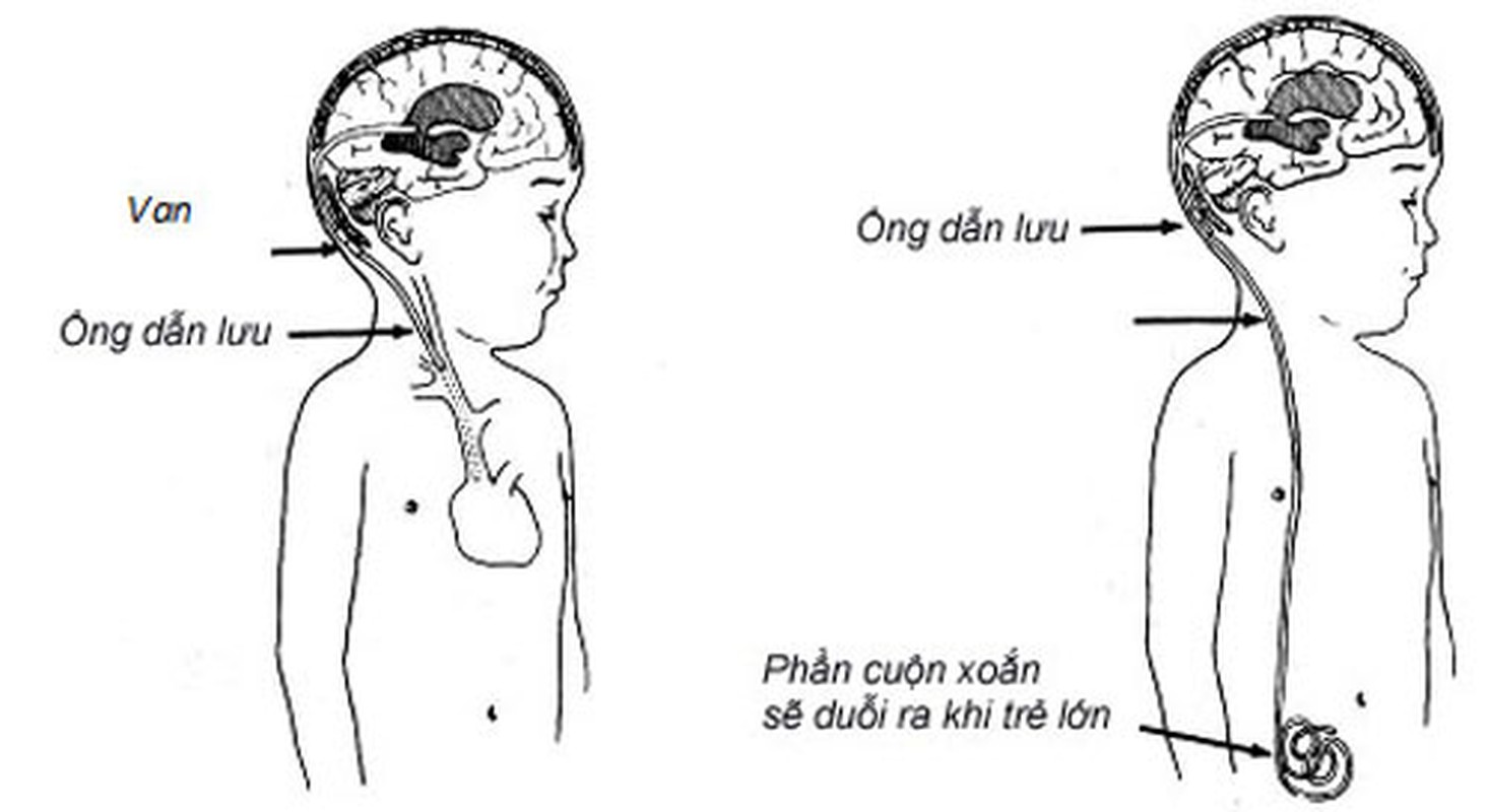 Benh hiem cua Quoc vuong Thai Lan có chũa duọc khong?-Hinh-7