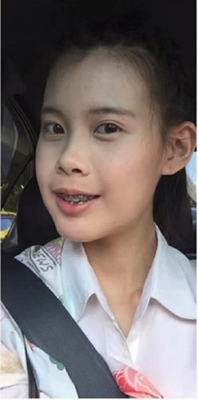 Anh truoc va sau dang kinh ngac cua thieu nu mat lech-Hinh-6