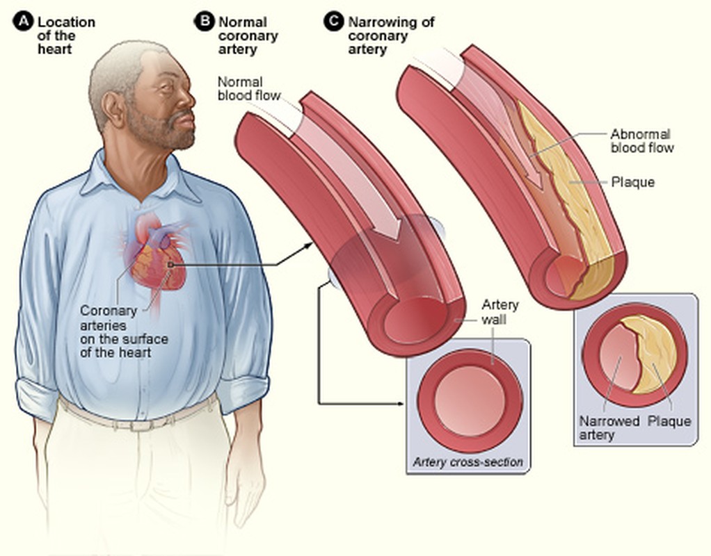 Ly giai hien tuong cholesterol cao o nguoi gay-Hinh-3